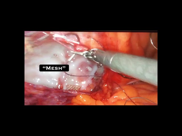 How I hide the mesh behind the muscle during laparoscopic inguinal hernia repair by Dr. Iraniha