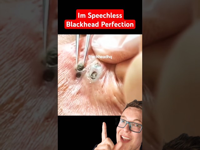 Crazy 3 In 1 Blackhead - ULTIMATE BLACKHEAD REMOVAL 2024 #shorts