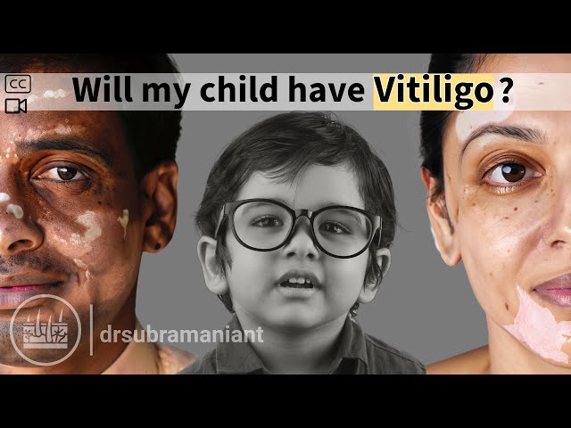 Every parent with vitiligo must know!