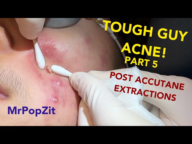 Tough guy acne! Cleaning out his last clogged pores. Every technique used. So many plugs expressed!