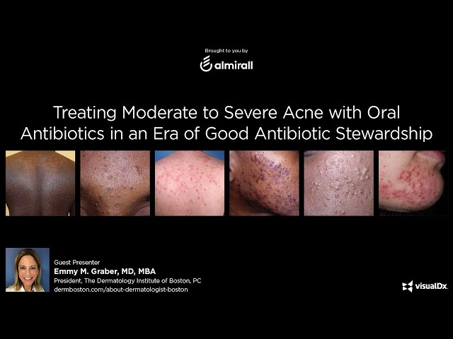 Treating Moderate to Severe Acne with Oral Antibiotics in an Era of Good Antibiotic Stewardship