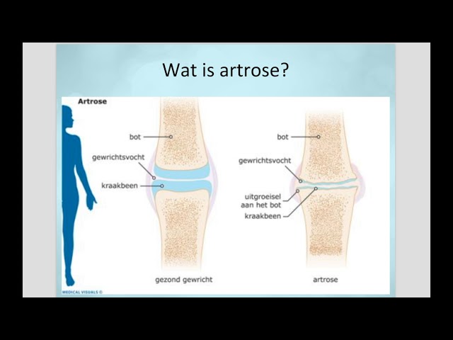 Wat is artrose? | Orthopeed Jan Ide de Jong