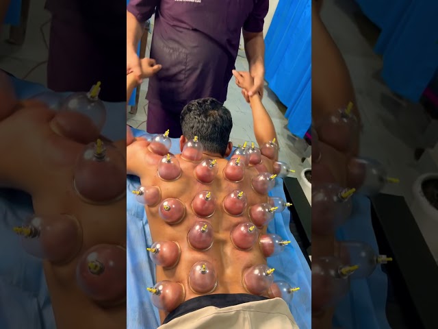 Shivam Mishra Cupping Therapy