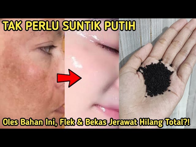 FLEK HITAM BEKAS JERAWAT HILANG TOTAL PAKAI BAHAN DAPUR INI?! WAJIB COBA!! MEMUTIHKAN WAJAH PERMANEN