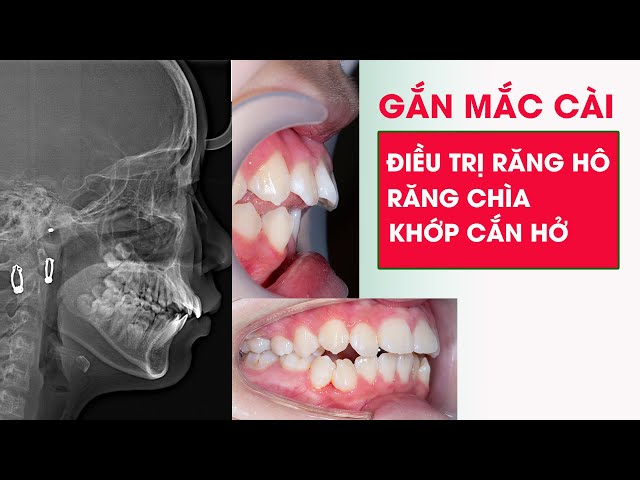 Gắn Mắc Cài | Niềng răng điều trị răng hô, chìa , khớp cắn hở cho bé gái 13 tuổi