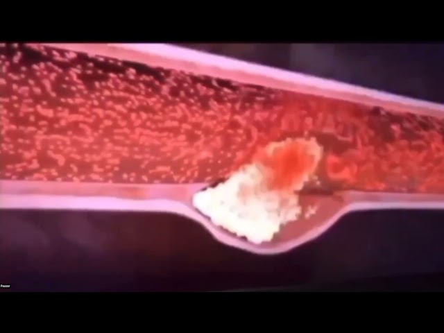 STEMI atheroma plaque rupture