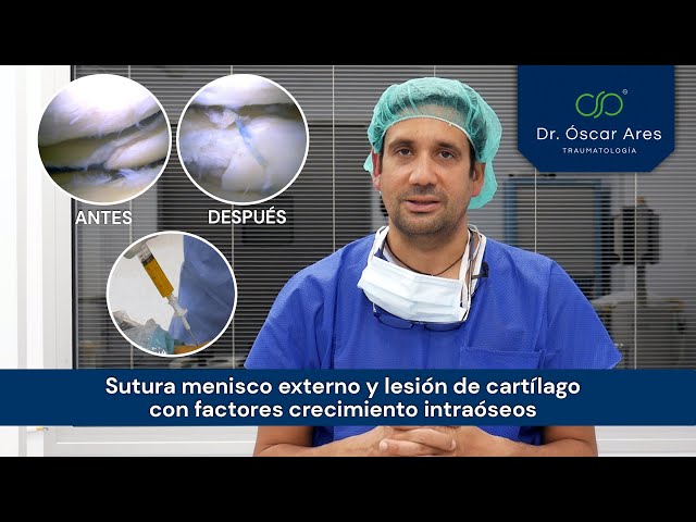 Sutura menisco externo y lesión de cartílago con factores crecimiento intraóseos - Dr. Ares