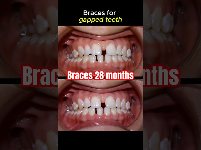 Braces for gapped. 28 months duration #braces #orthodontist #brackets #dentist