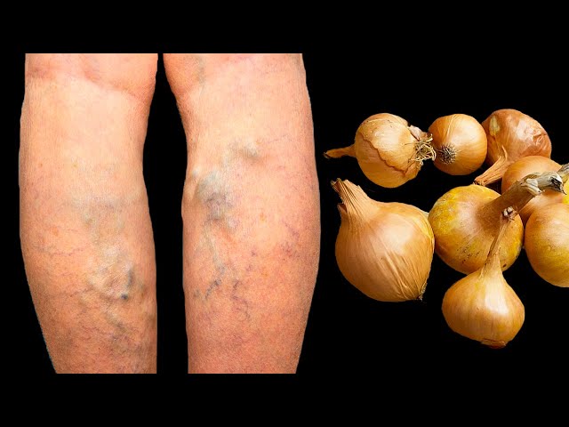 ❗Get rid of varicose veins forever! Incredible effect!😱 A natural remedy!