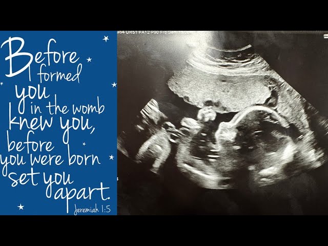 Pediatric Echocardiogram ll NICU update ll Trisomy 18 ?