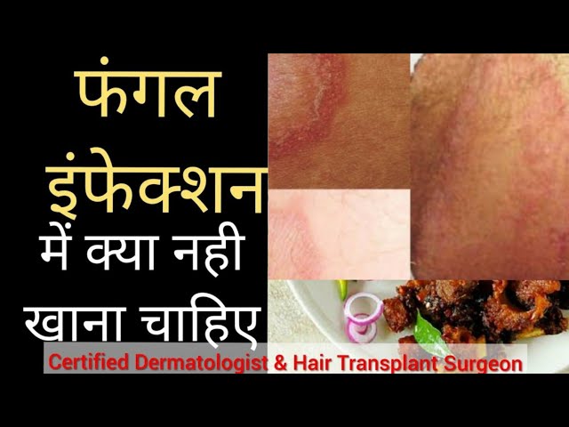 #Food for Fungal infection #dietinfungal फंगल इंफेक्शन में क्या खाना चाहिए