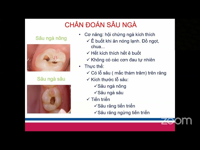 Phân loại sâu răng