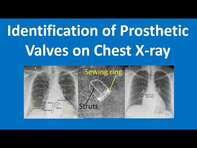 Identification of Prosthetic Valves on Chest X ray