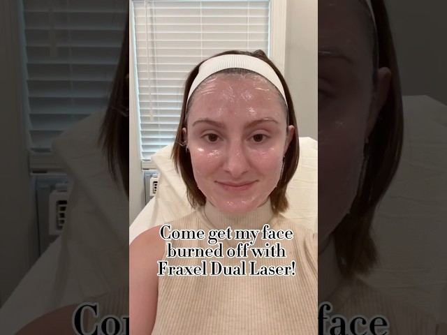 Recovery week from Fraxel dual laser 😅 #lasertreatment #skincare #acnescars #minivlog