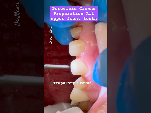 Upper Front teeth Crowns Preparation with temporary video