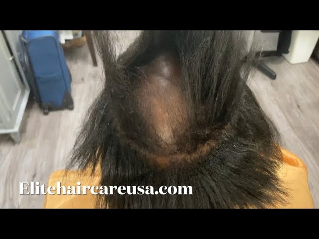 How to fix damaged hair| Alopecia weaving alternative |How to cover a bald spot with weave