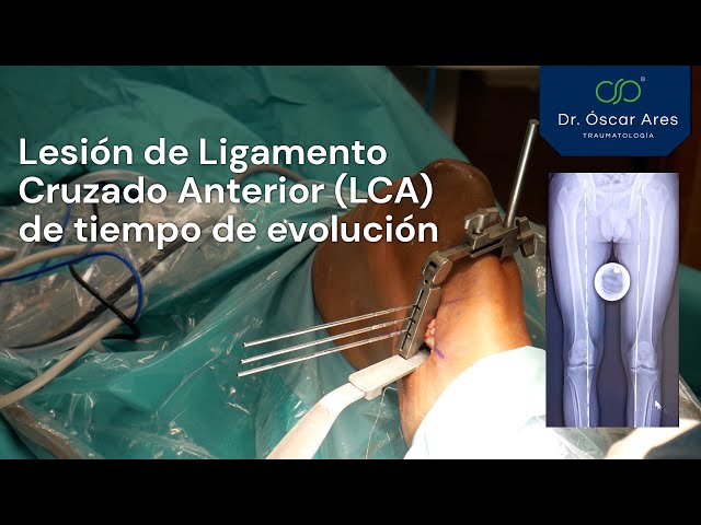 Reconstrucción LCA y Osteotomía de adición - Dr. Oscar Ares