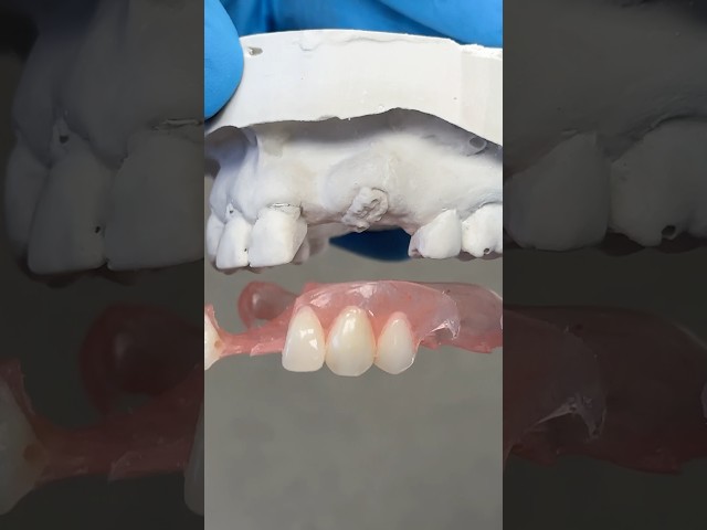 Filling in with a Partial #lsk121shorts #dental #teeth