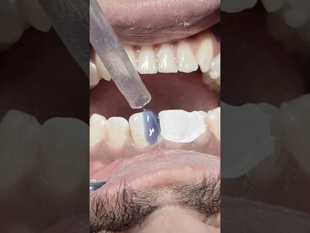 Anterior teeth composite restoration #dentist #dental