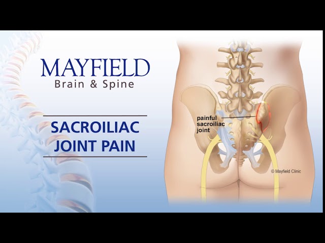 Mayfield Minute: Sacroiliac Joint Pain (SI Joint Pain )