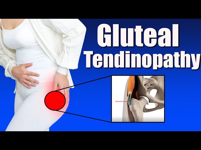 Gluteal Tendinopathy: Symptoms, Causes, and Effective Exercises for Greater Trochanter Pain