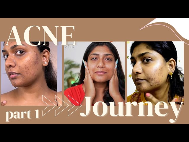 3 years of acne journey part 1 | acne skincare tips in tamil , pimples 9/22