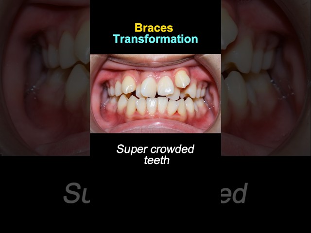 Braces fix all problem crooked teeth #braces #orthodontist #dentist #dentisty