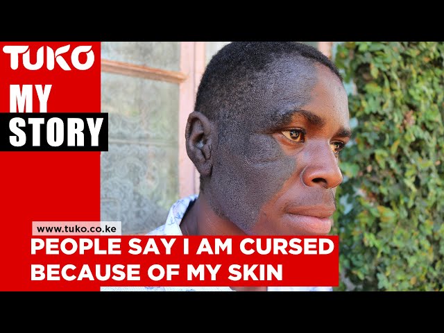 People rejected me because of my skin and said I was cursed - Alvin Mwaura | My Story | Tuko TV