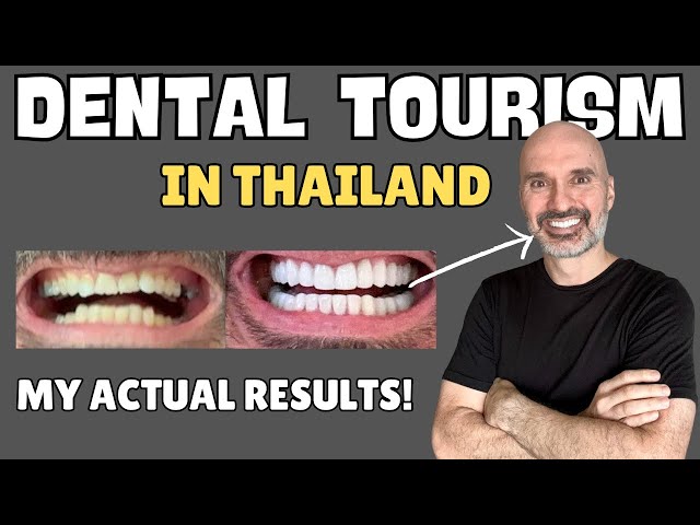 I Got 22 Crowns & 6 Veneers in Thailand 🇹🇭 SHOCKING Dental Tourism Makeover