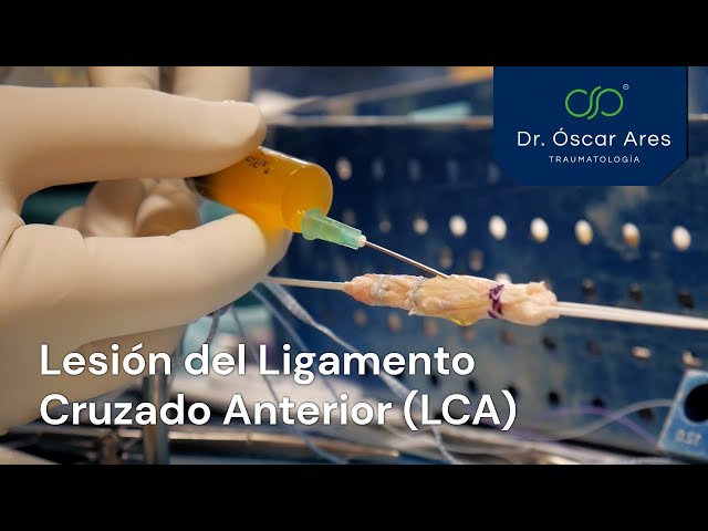 Lesión del Ligamento Cruzado Anterior (LCA)