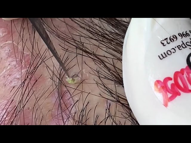 Big Cystic Acne Blackheads Extraction Blackheads & Milia, Whiteheads Removal Pimple Popping #shorts