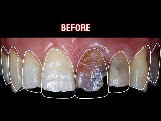 Demo dán sứ veneer | Veneers dental Demo #smiledesign