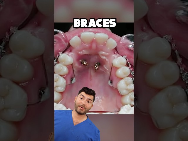 Braces Explained !?