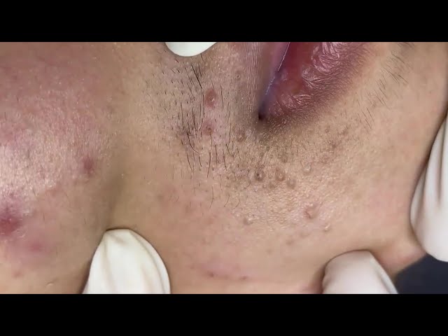 Big Cystic Acne Blackheads Extraction Blackheads & Milia, Whiteheads Removal Pimple Popping