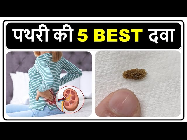 5 BEST किडनी की पथरी की दवा