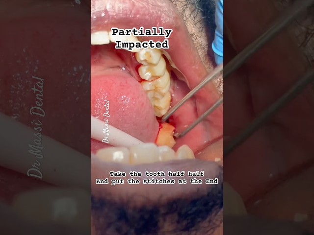 Is that Necessary to Remove Wisdom  Teeth?