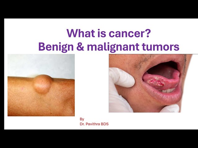 what is cancer? what is benign tumor & malignant tumor?#cancer #life #learning