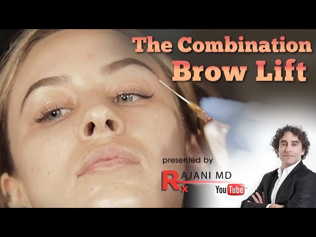 PDO BROW LIFT //  PDO Sculptra Brow Lift Hooded Eyes