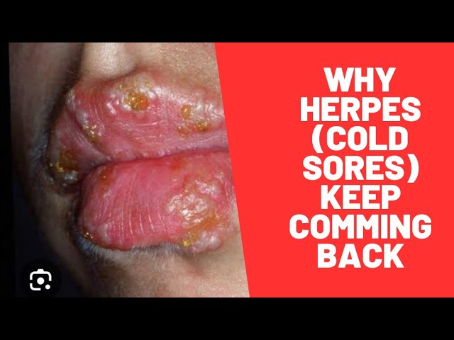 Herpes Simplex: Spread, Prevention & Treatment