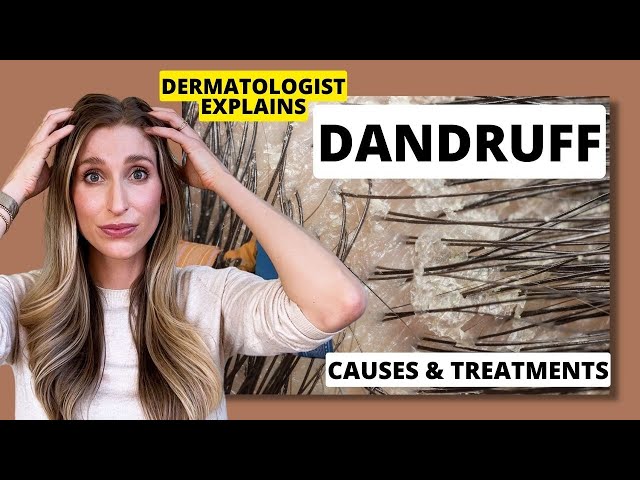 Dermatologist Explains Dandruff: What Causes it & Best Dandruff Treatments! | Dr. Sam Ellis