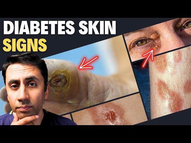 Doctor Explains 13 Skin Signs of Diabetes - Never Ignore These Symptoms (High Sugar)