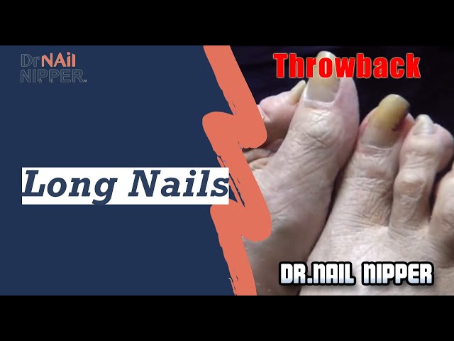 Have you seen Toenails This Long? [Throwback]