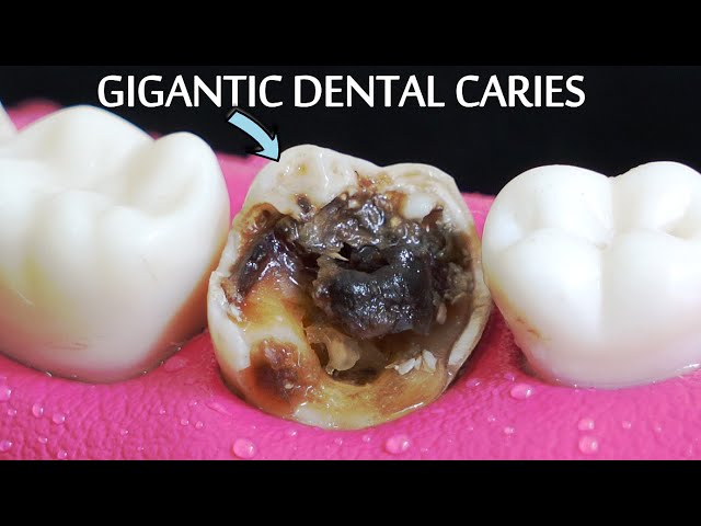 INCREDIBLY SATISFYING Restoration Of Massive Tooth Decay | Root Canal And Crown Process.