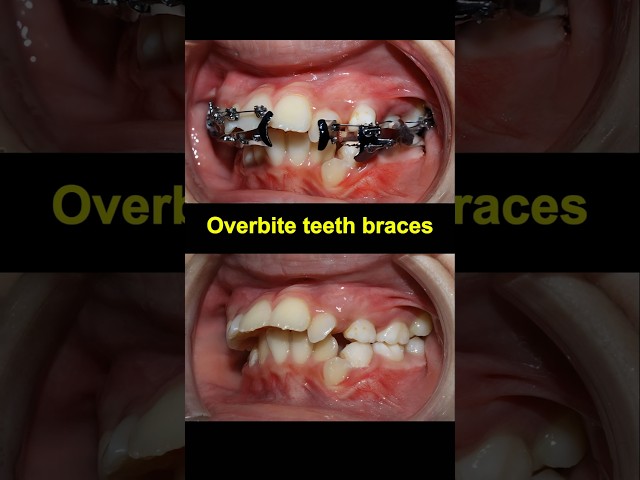 Braces time lapse. Fix Overbite teeth #braces #orthodontist #dentist #dentistry