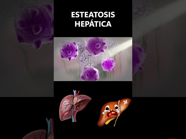 Esteatosis Hígado Graso: La Enfermedad Silenciosa que Nadie Está Detectando