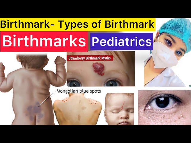 Pediatrics | Birthmarks || Types of Birthmarks | Stroke Spot | Milia Spot | Strawberry Spot | Pedia