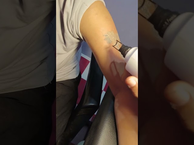 #laser tattoo remove #remove tattoo laser #trending #trend #viral