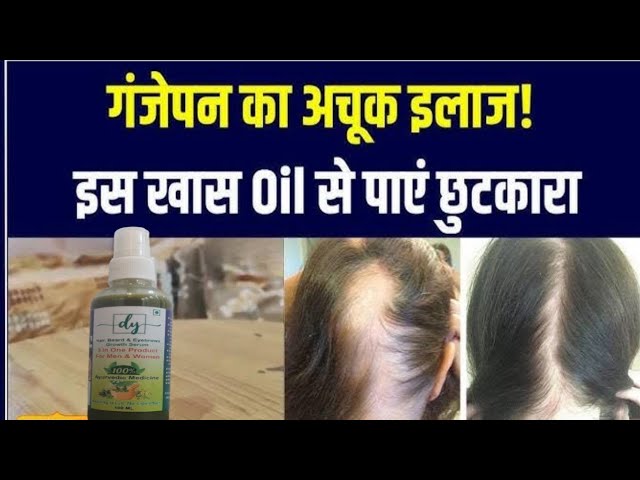 Hair regrowth serum Online order from 4 states | ganjapan dur kare 100% | best hair growth serum