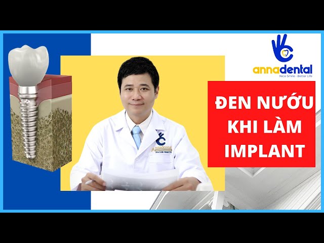 MỌI ĐIỀU BẠN CẦN BIẾT VỀ ĐEN NƯỚU SAU KHI LÀM IMPLANT | NHA KHOA ANNA