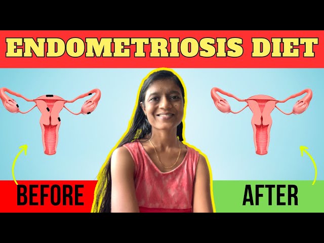 Endometriosis Diet | Foods to Eat and Avoid in Endometriosis